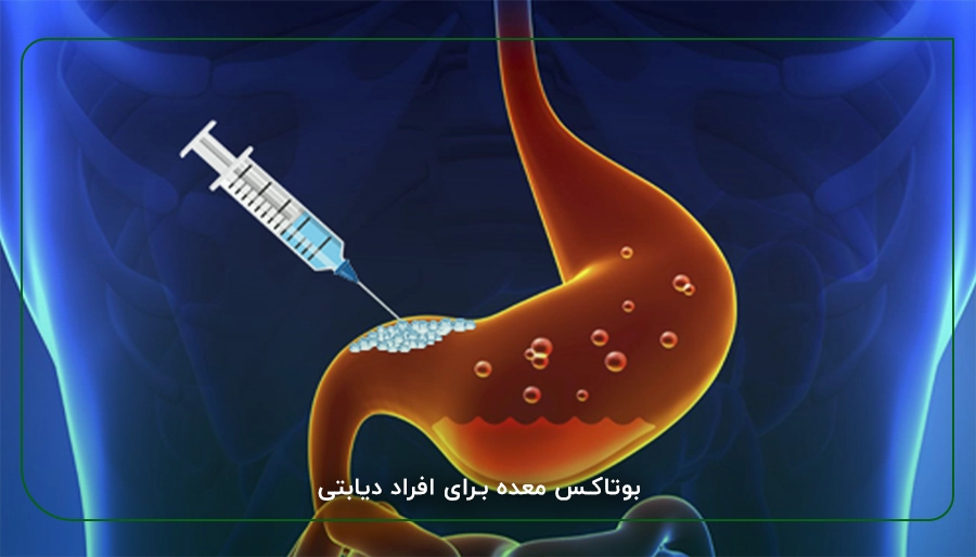 بوتاکس معده برای افراد دیابتی