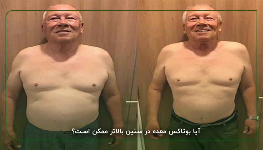 آیا بوتاکس معده در سنین بالاتر ممکن است؟