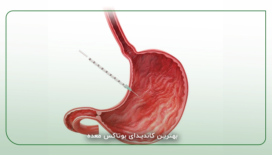 بهترین کاندیدای بوتاکس معده