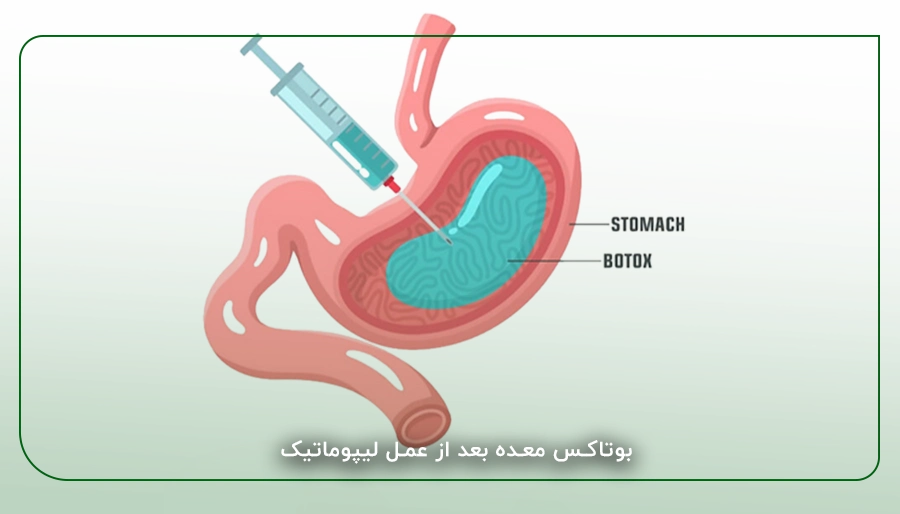 بوتاکس معده بعد از عمل لیپوماتیک
