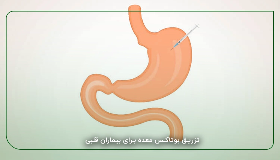 تزریق بوتاکس معده برای بیماران قلبی