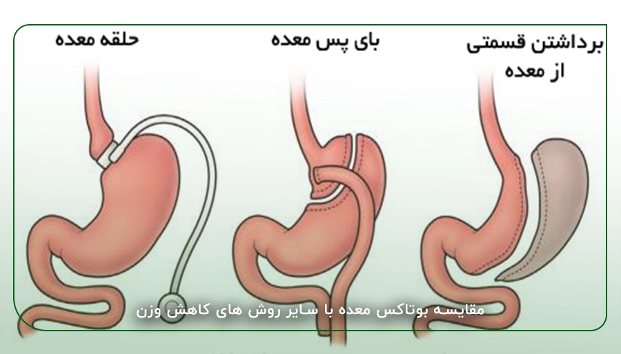مقایسه بوتاکس معده با سایر روش های کاهش وزن