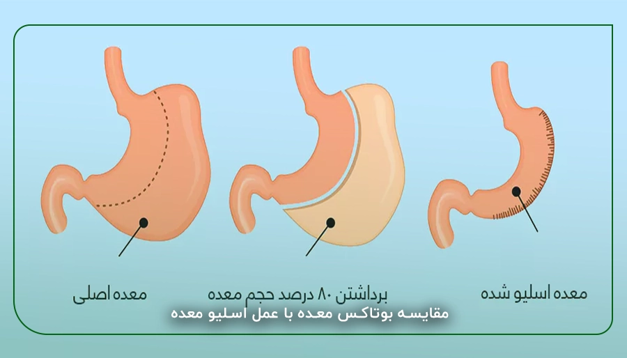 مقایسه بوتاکس معده با عمل اسلیو معده