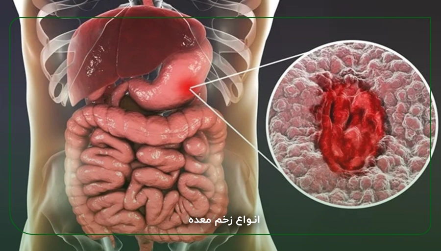 انواع زخم معده