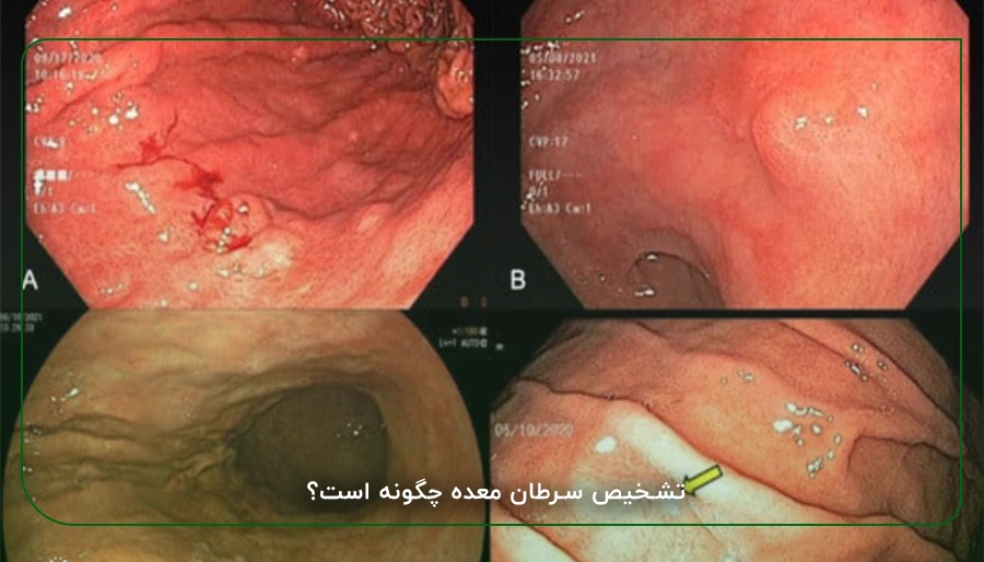 تشخیص سرطان معده چگونه است؟