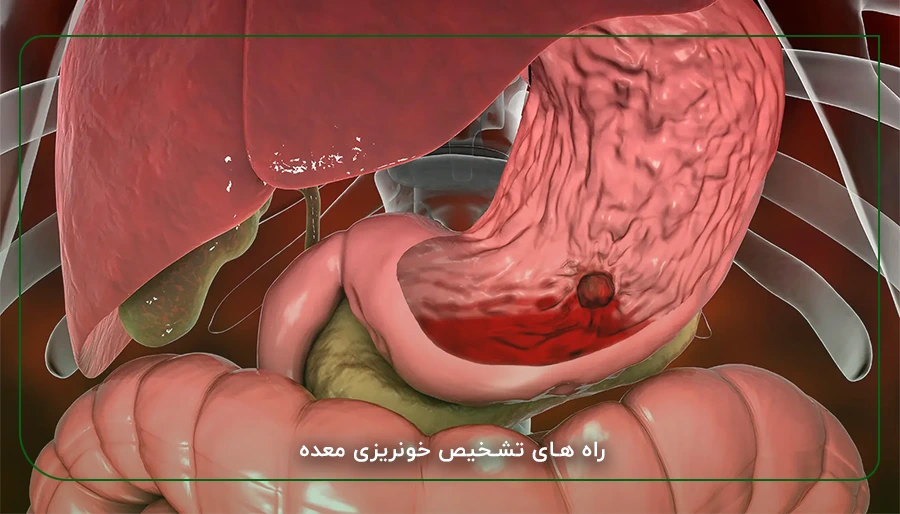 راه های تشخیص خونریزی معده