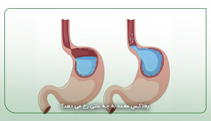 رفلاکس معده به چه علتی رخ می دهد؟
