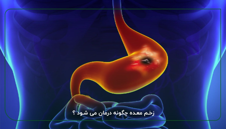 زخم معده چگونه درمان می شود ؟