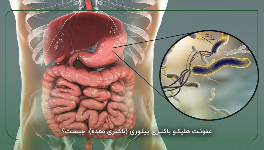 عفونت هلیکو باکتری پیلوری (باکتری معده) چیست؟