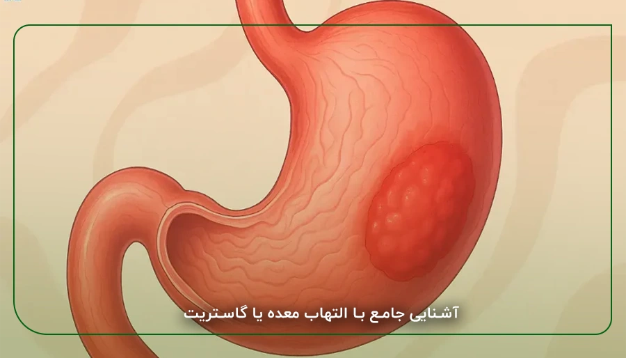 آشنایی جامع با التهاب معده یا گاستریت