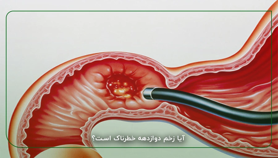 آیا زخم دوازدهه خطرناک است؟