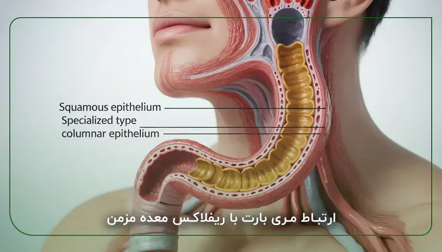 ارتباط مری بارت با ریفلاکس معده مزمن