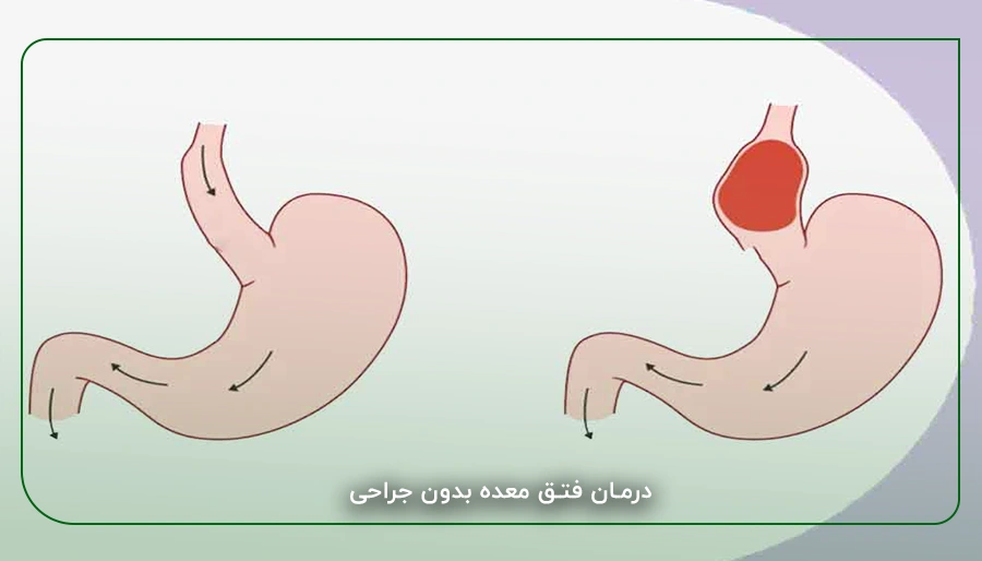درمان فتق معده بدون جراحی