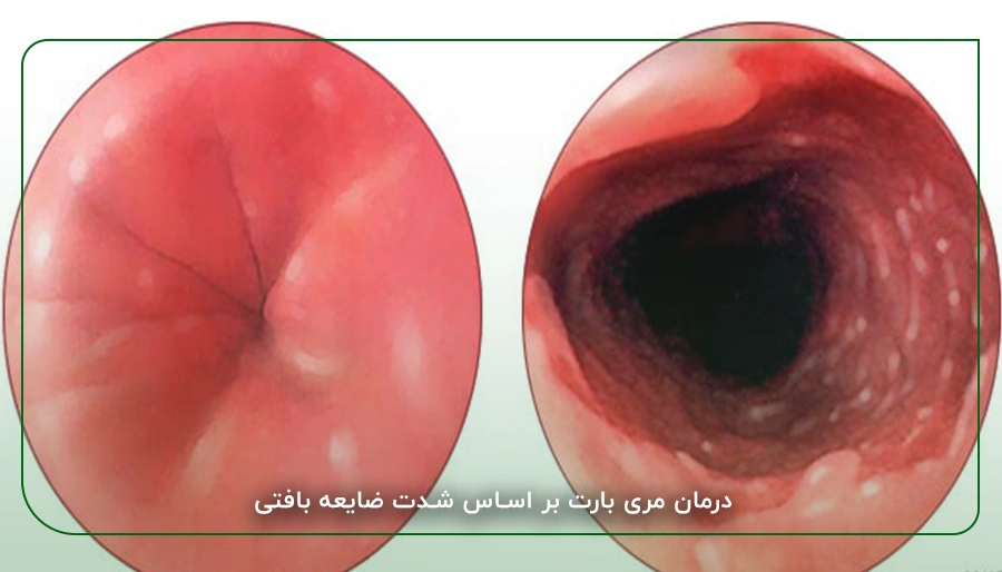 درمان مری بارت بر اساس شدت ضایعه بافتی