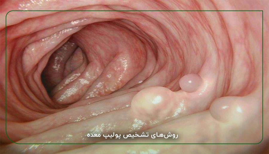 روش_های تشخیص پولیپ معده