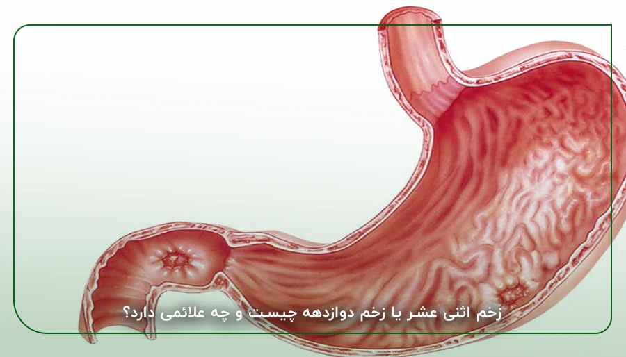 زخم اثنی عشر یا زخم دوازدهه چیست و چه علائمی دارد؟