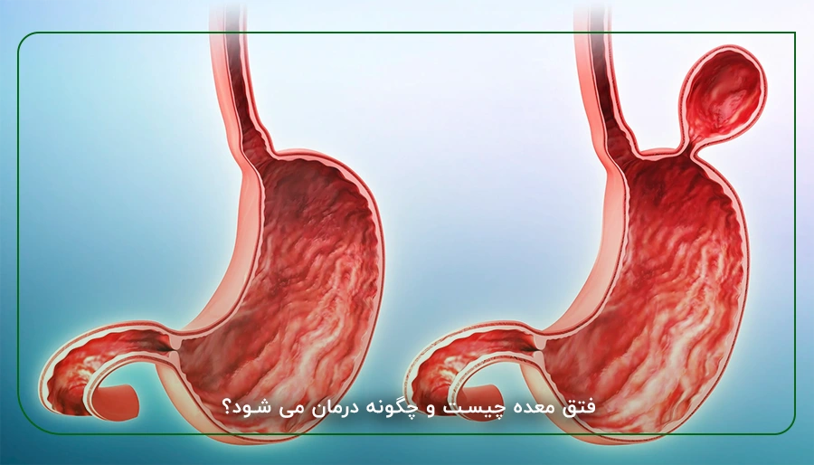 فتق معده چیست و چگونه درمان می شود؟