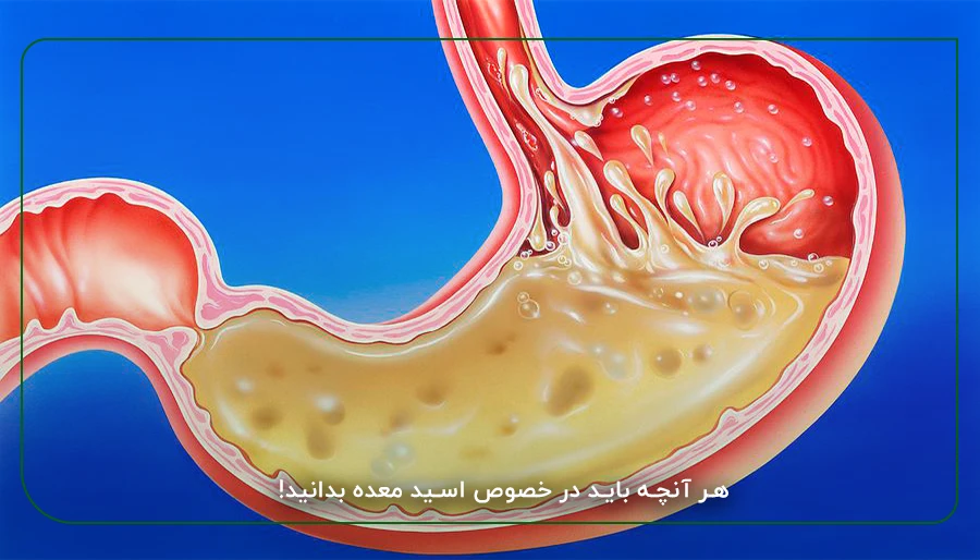 هر آنچه باید در خصوص اسید معده بدانید!