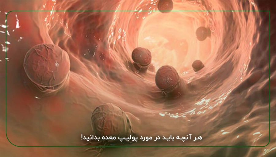 هر آنچه باید در مورد پولیپ معده بدانید!