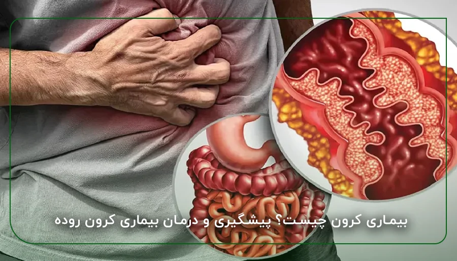 بیماری کرون چیست؟ پیشگیری و درمان بیماری کرون روده