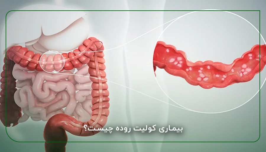بیماری کولیت روده چیست؟