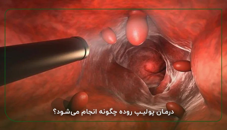 درمان پولیپ روده چگونه انجام می‌شود؟