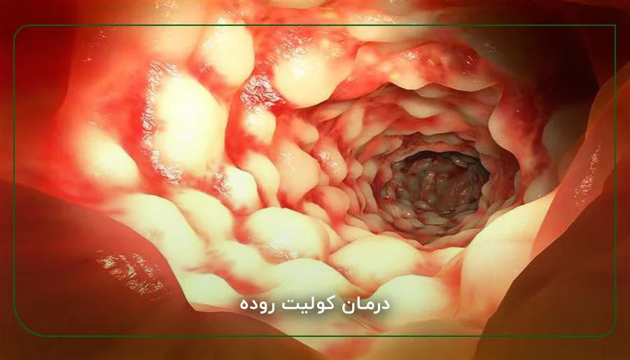 درمان کولیت روده