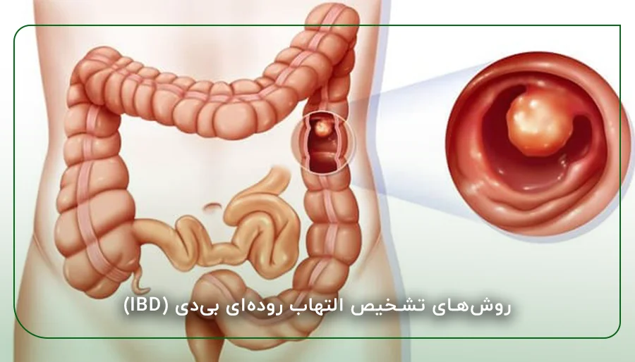 روش‌های تشخیص التهاب روده‌ای بی‌دی (IBD)