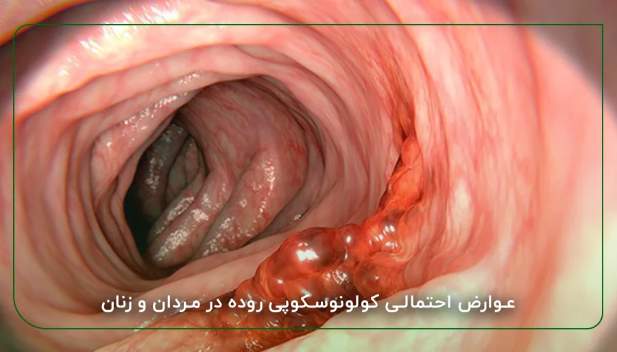 عوارض احتمالی کولونوسکوپی روده در مردان و زنان