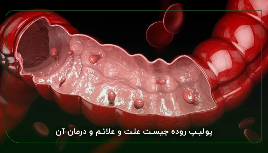 پولیپ روده چیست علت و علائم و درمان آن