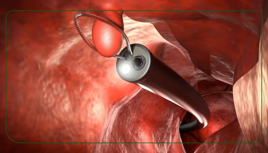 جواب کولونوسکوپی