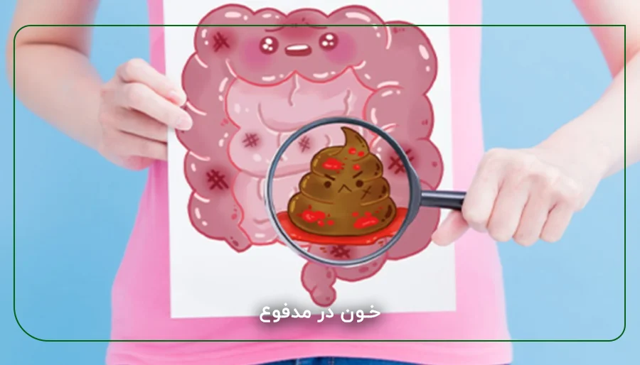 خون در مدفوع