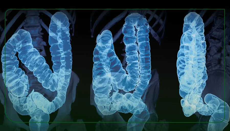 دیورتیکولیت