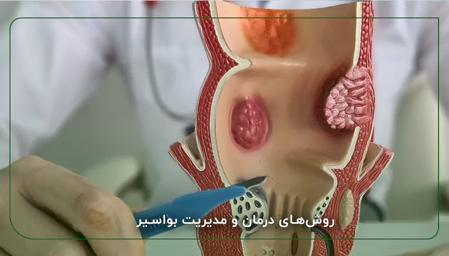 روش‌های درمان و مدیریت بواسیر