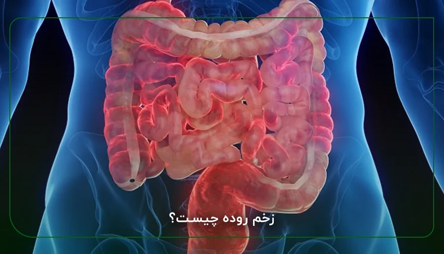 زخم روده چیست؟