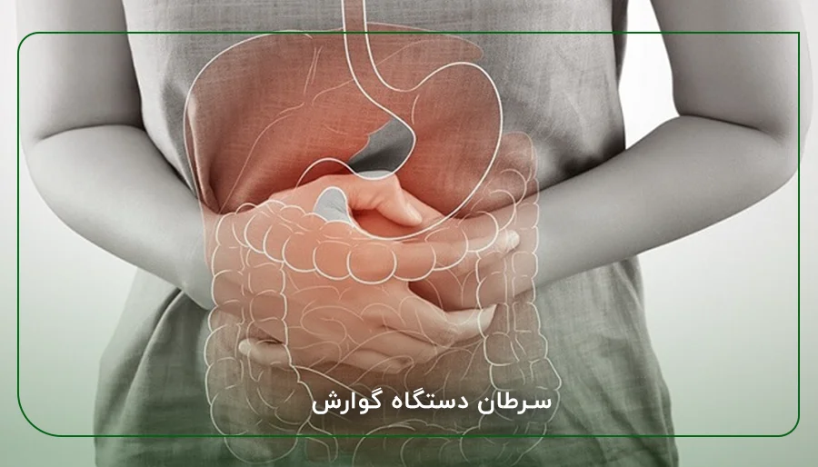 سرطان دستگاه گوارش