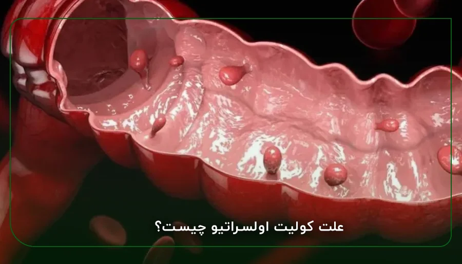 علت کولیت اولسراتیو چیست؟