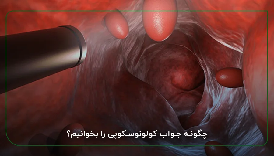 چگونه جواب کولونوسکوپی را بخوانیم؟