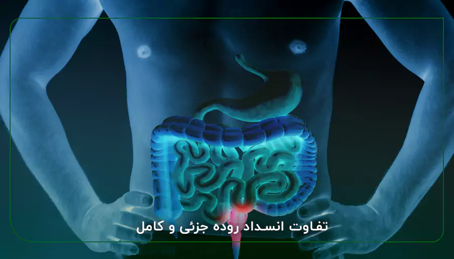 تفاوت انسداد روده جزئی و کامل