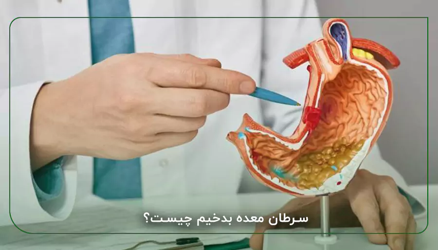 سرطان معده بدخیم چیست؟