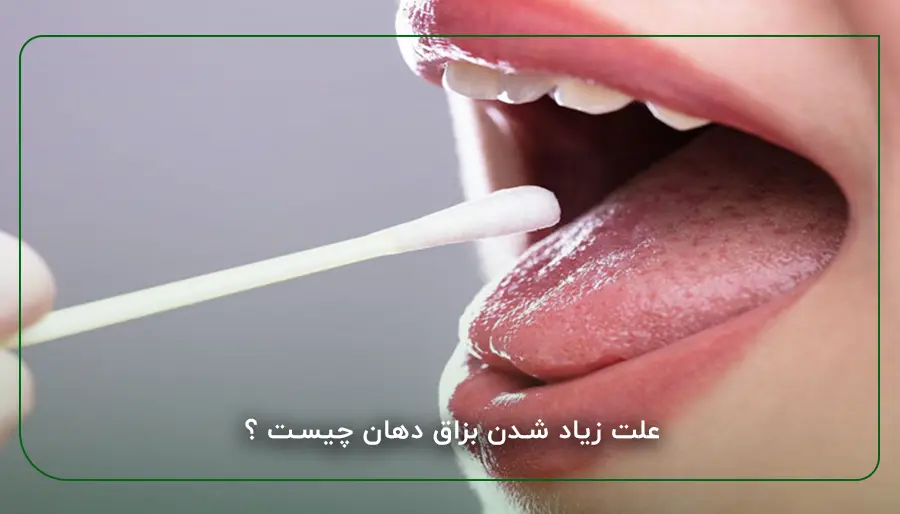 علت زیاد شدن بزاق دهان چیست