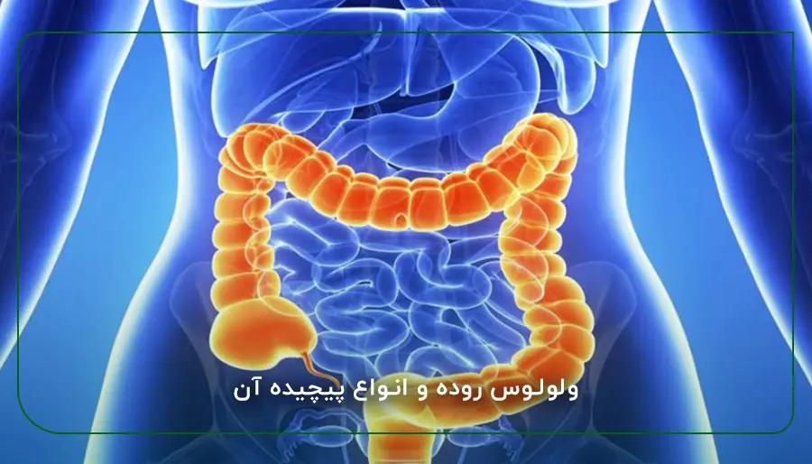ولولوس روده و انواع پیچیده آن
